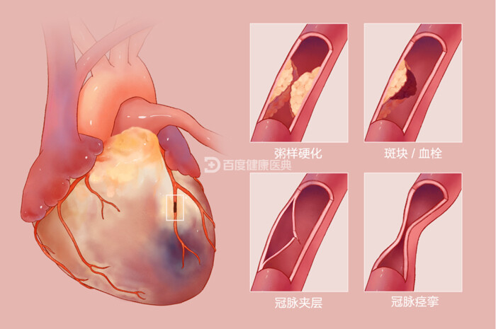 深扒急性心梗身故被拒赔凭啥